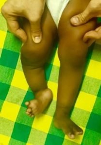 Child Bone Specialist in Kolkata