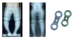 Child Bone Specialist in Kolkata