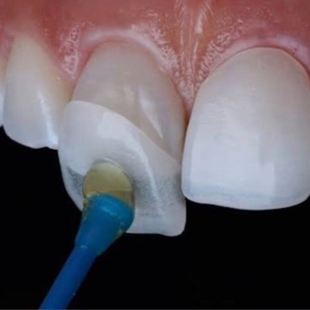 Dental Fillings for Kids