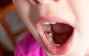 Dental Fillings for Kids
