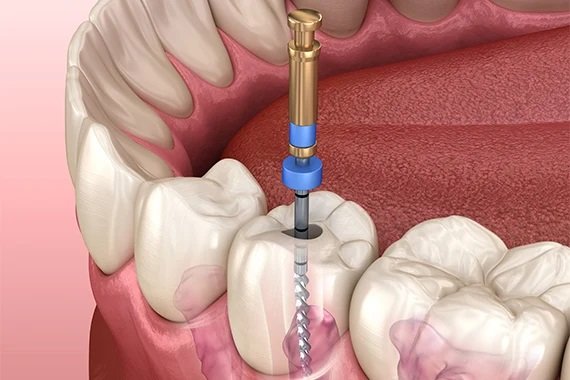 pediatric root canal specialist