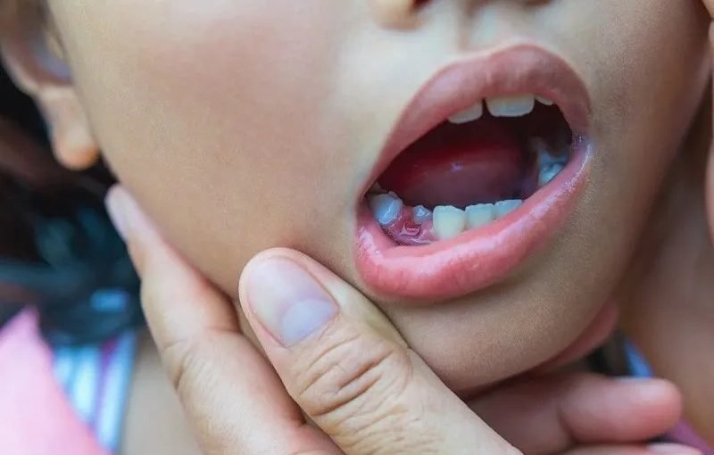 Root Canal Treatment for Children: Is It Safe?