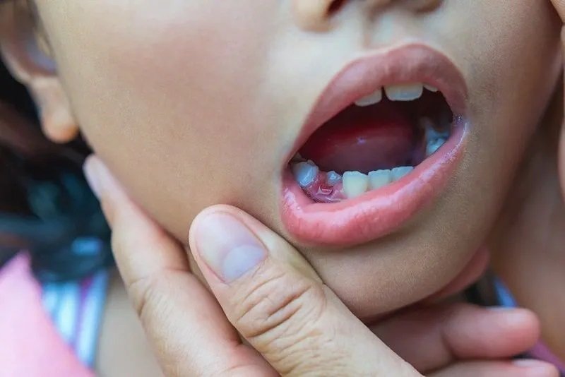 Root Canal Treatment for Children: Is It Safe?