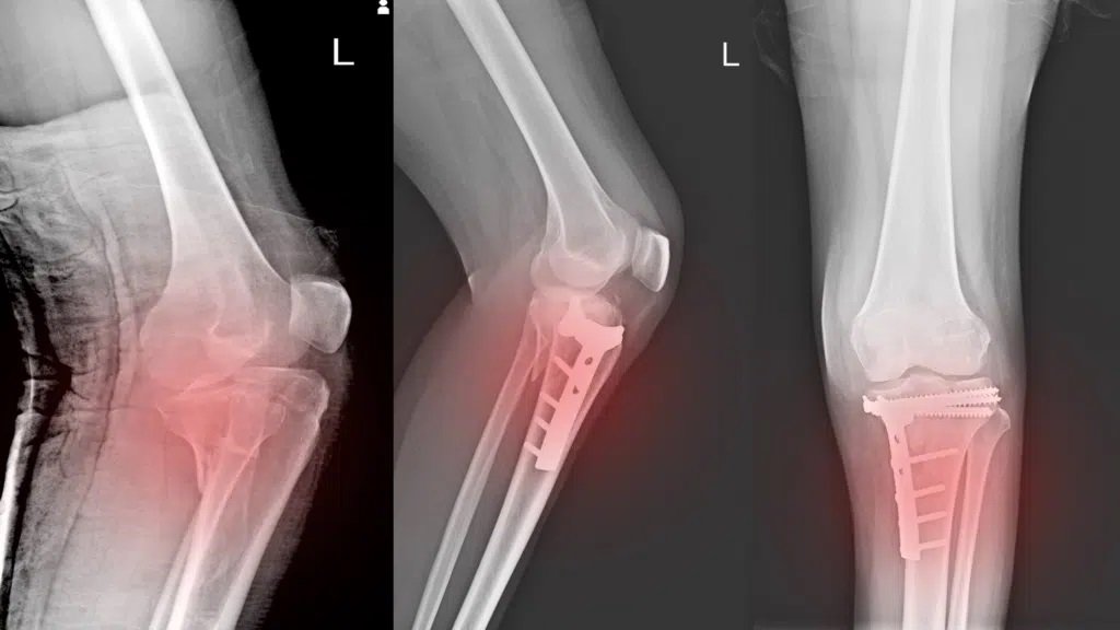 Growth Plate Injury Treatment