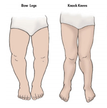 Bow Legs & Knock Knees in Children