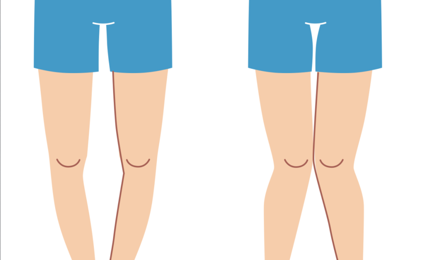 Bow Legs and Knock Knees in Children: When Should Parents Worry?