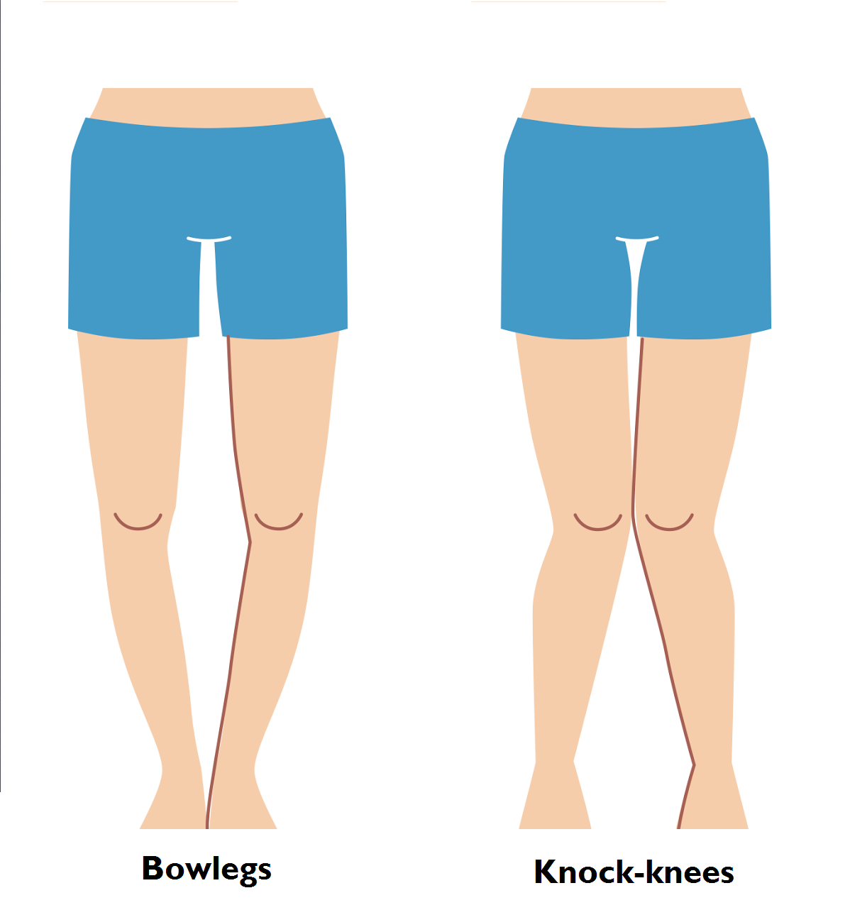 Bow Legs and Knock Knees in Children: When Should Parents Worry?