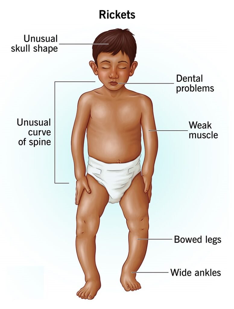 Bone Deformity Treatment for Child in Kolkata