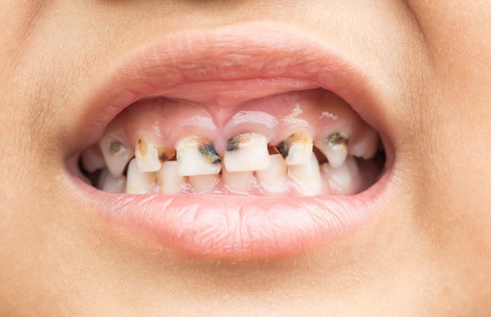 Why Children Get Cavities and How to Prevent Them