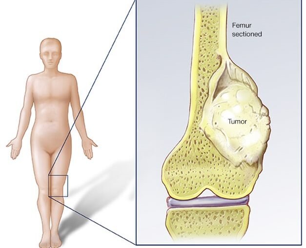 Bone Tumors in Children: Warning Signs Every Parent Should Know