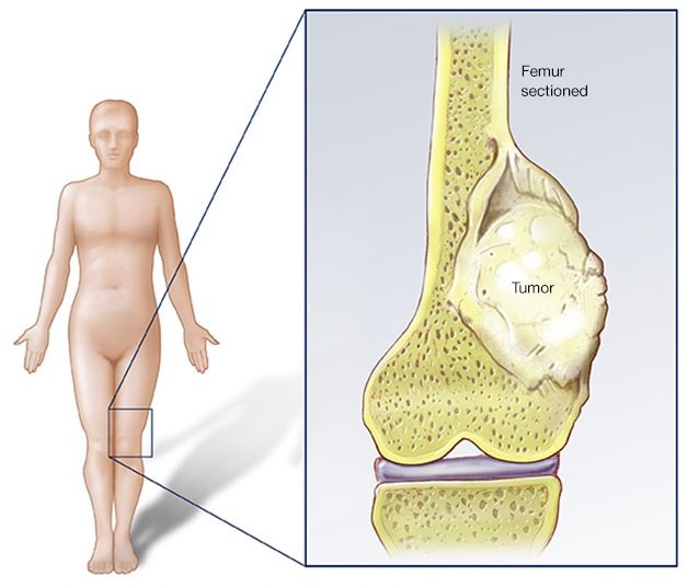 Bone Tumors in Children: Warning Signs Every Parent Should Know