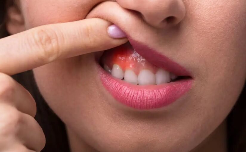 Bleeding Gums in Children: Causes and Treatment