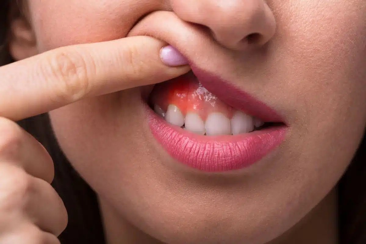 Bleeding Gums in Children: Causes and Treatment