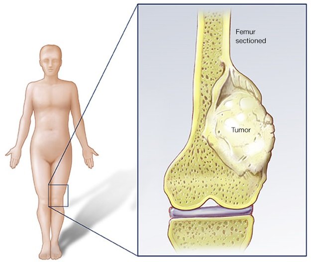 Malignant Bone Tumors