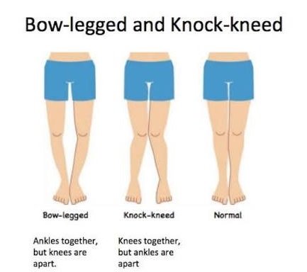 Bow Legs & Knock Knees in Children